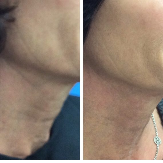 1 Ultherapy tx Jawline and neck