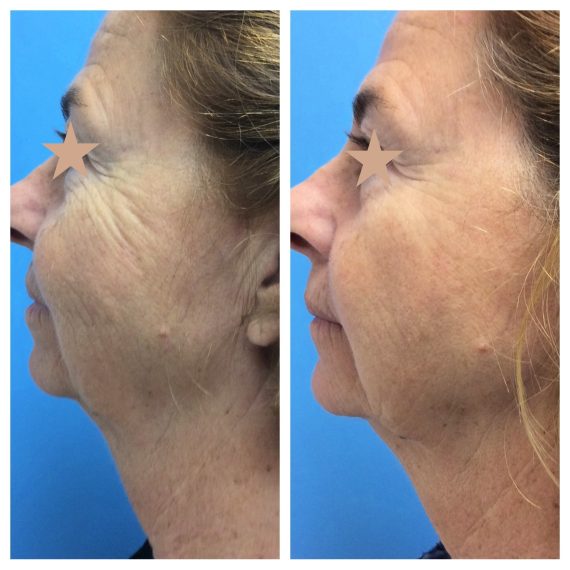 1 tx Ultherapy 6 months post