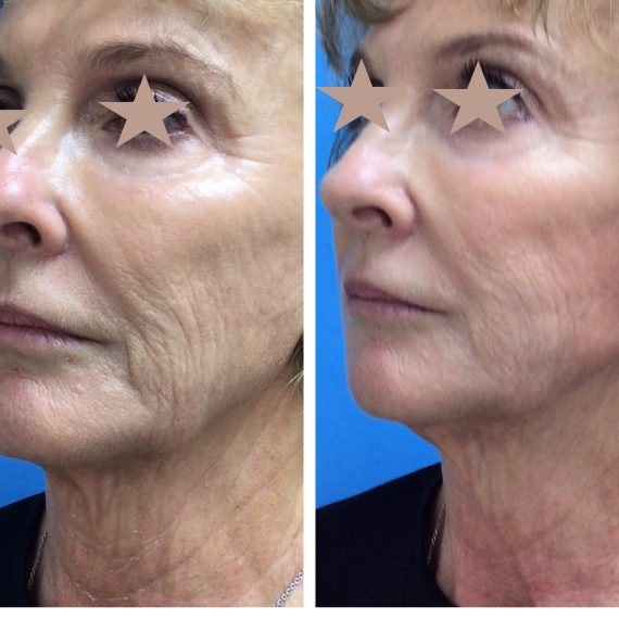 4 months post Ultherapy